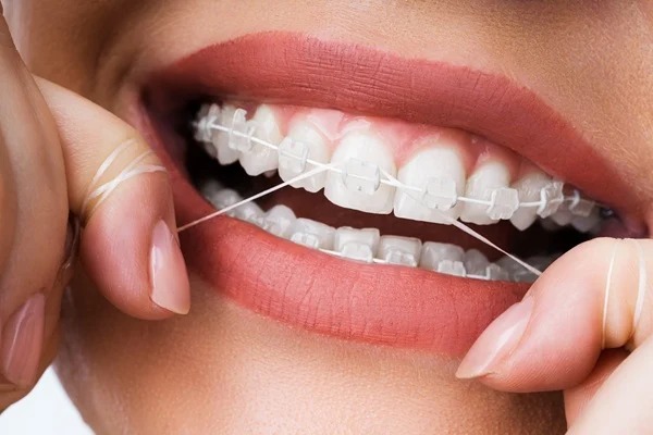 Reasons To Consider Clear Braces For Teens