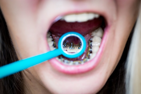 Lingual Braces Are A Discreet Teeth Straightening Treatment