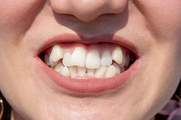 An Orthodontist Shares Some Common Causes Of Crowded Teeth