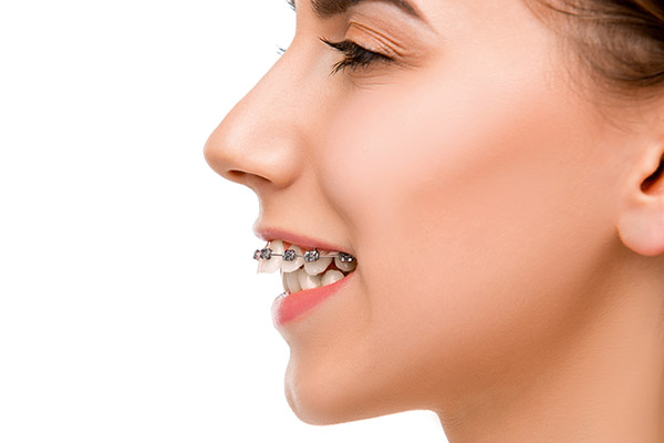 Orthodontist Treatment Options for an Overbite from Frisco Family Orthodontics in Frisco, TX